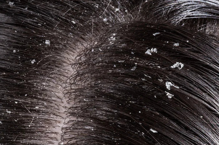 Cuir chevelu sensible, démangeaisons et pellicules : comment retrouver l’équilibre naturellement ?